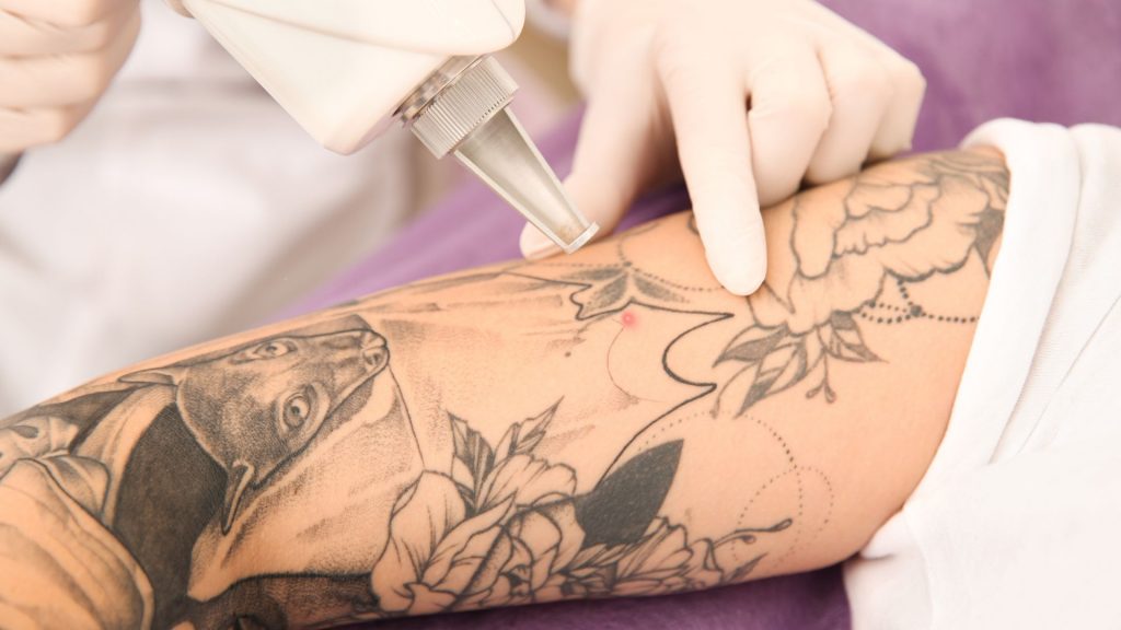 Na ramieniu kobiety przeprowadzane jest laserowe usuwanie tatuażu.